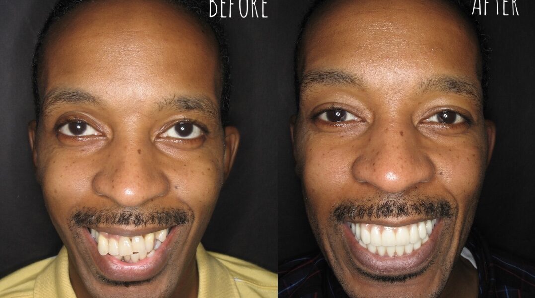 Dental Bridge before And After