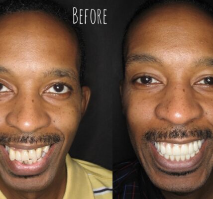 Dental Bridge before And After