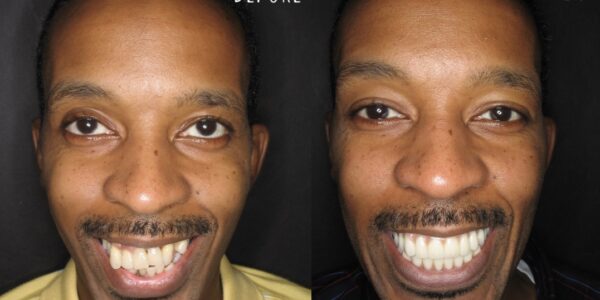 Dental Bridge before And After