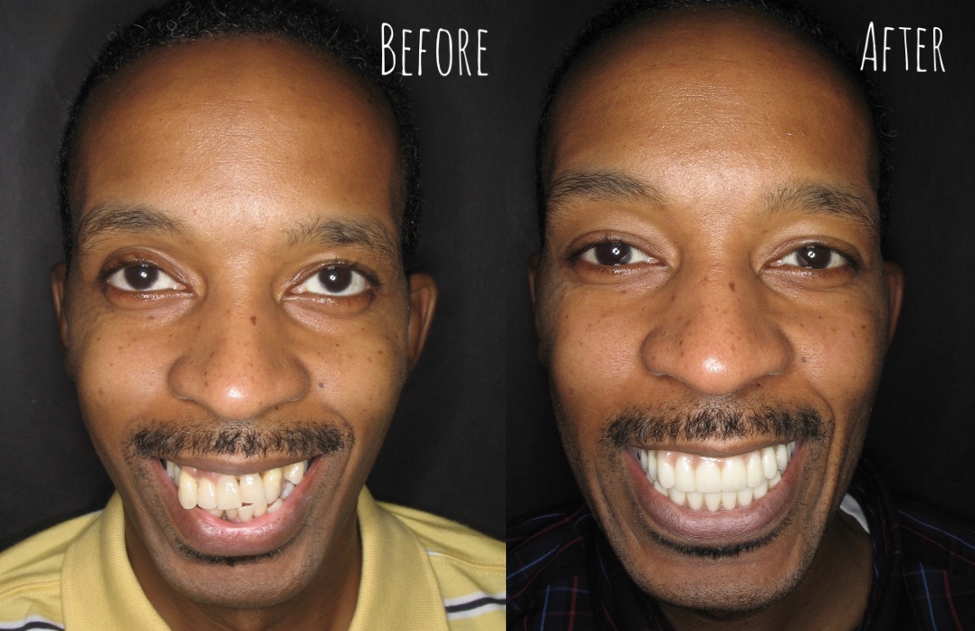 Dental Bridge before And After